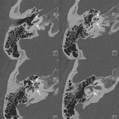 Pulsatile Tinnitus Otospongiosis | neuroangio.org