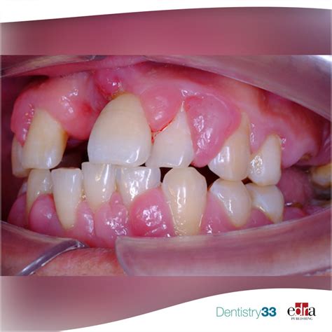 How to manage drug-induced gingival hyperplasia | Dentistry33