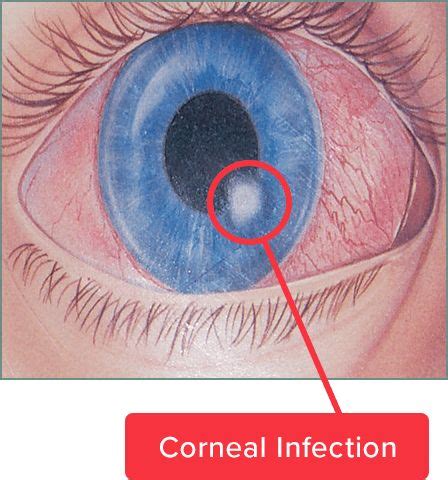 Corneal Infection Symptoms & Treatments - NEOES