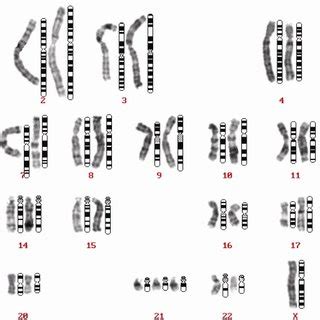 A karyogram indicating a fetal Down syndrome with trisomy 21 (same... | Download Scientific Diagram