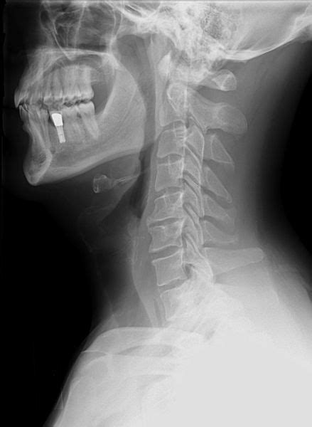 Treating Patients with Cervical Lordosis - The Colorado Physical Therapy Network