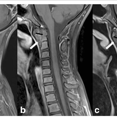 MRI of cervical spine (patient #8)(T1 TSE FS sagittal with a contrast ...