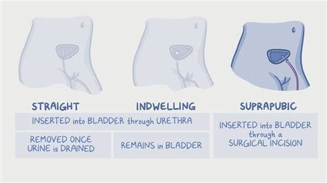 Genitourinary: Urinary Catheters And Routine Indwelling, 40% OFF