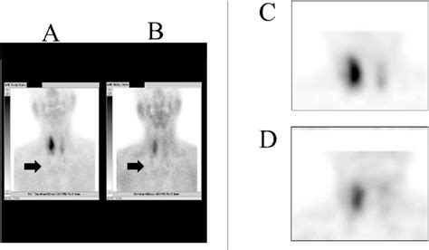 99m Tc-MIBI scan. No significant uptake in the mediastinal mass was... | Download Scientific Diagram