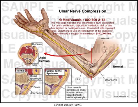 Ulnar Nerve Compression Medical Illustration Medivisuals