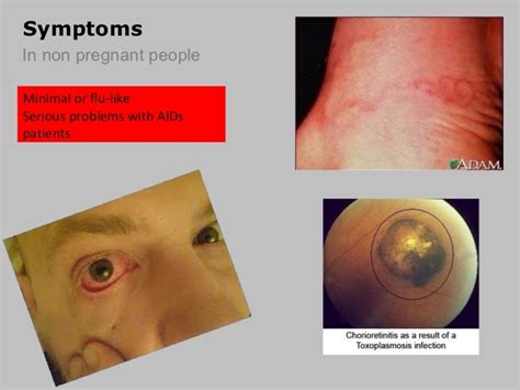 Toxoplasmosis Skin Rash Pictures