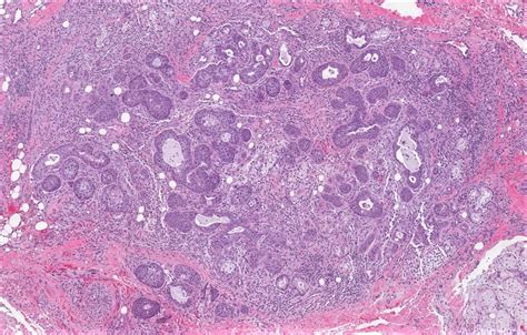 Necrotizing Sialometaplasia Histology