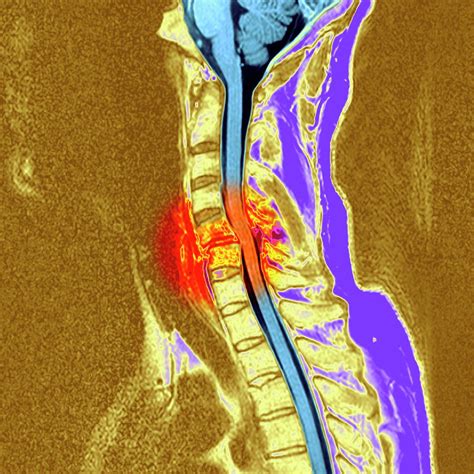 Broken Neck Photograph by Simon Fraser/newcastle Hospitals Nhs Trust/science Photo Library ...