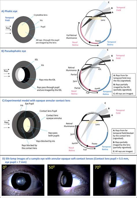 Schematic illustration of the iris and lens as viewed from the far... | Download Scientific Diagram