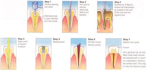 Root Canal Treatment in Mulund | Cost of Root Canal Treatment in Mulund ...