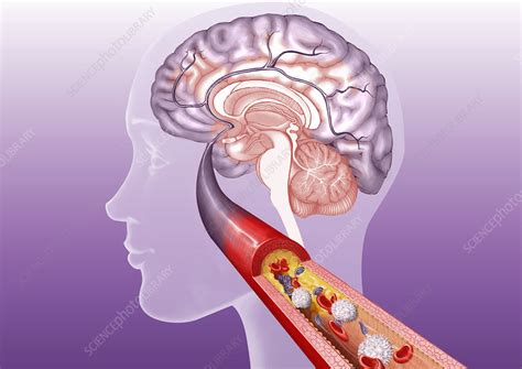 Cerebral artery thrombosis - Stock Image - C006/3975 - Science Photo Library