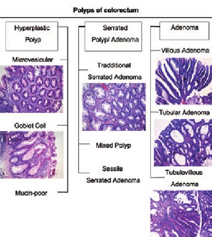 Colon Polyps Types