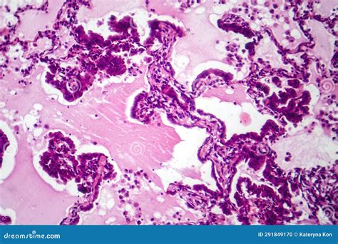 Lung Adenocarcinoma, Light Micrograph Stock Photo - Image of laboratory ...