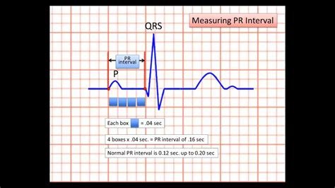 Sample of EKG strip reading for web QT HD - YouTube