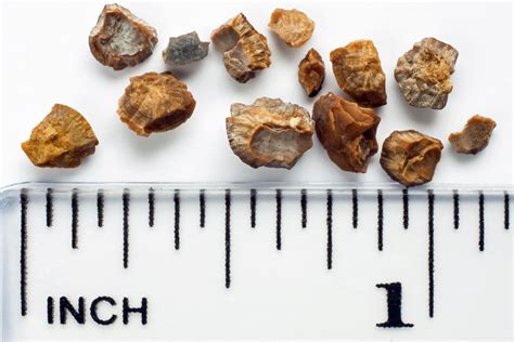 The four types of kidney stones (and how to limit them) - KSPtabs