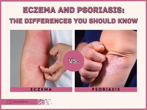 Psoriasis vs. Eczema: How to Tell Them Apart - Remotederm