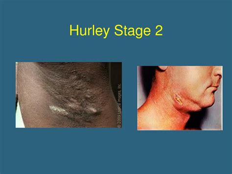 PPT - Hidradenitis Suppurativa PowerPoint Presentation - ID:595951