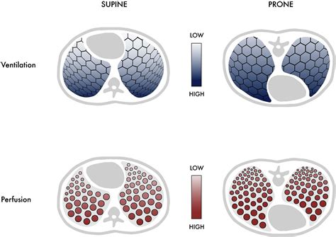 Prone Positioning for Acute Hypoxemic Respiratory Failure and ARDS - CHEST