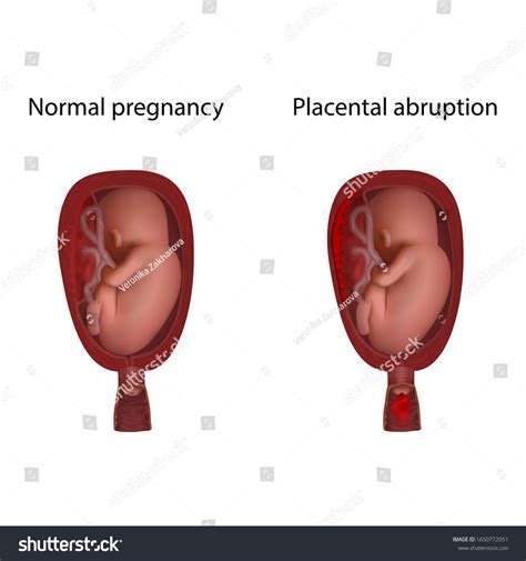 Placental abruption Images, Stock Photos & Vectors | Shutterstock