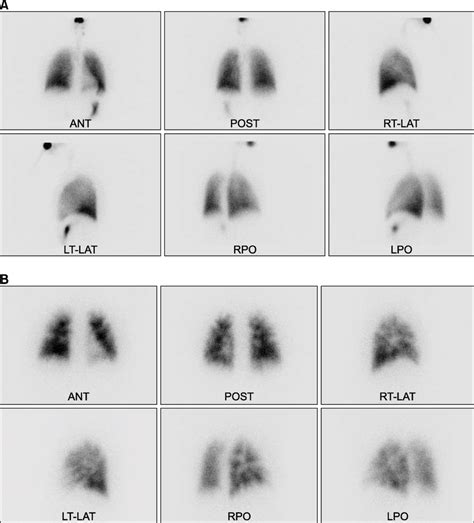 Perfusion Scan Lung Segment Map