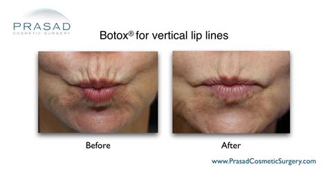 What’s the Best Treatment for Wrinkles Above Lips? | Dr. Prasad Blog