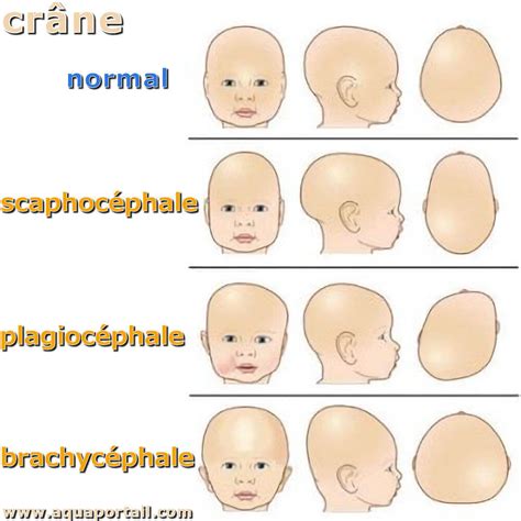 Dolichocéphalie : définition et explications