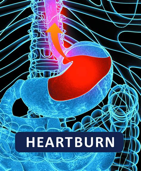 Does heartburn feel like a heart attack? - Harvard Health