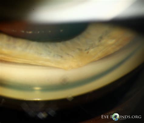 High peripheral anterior synechia in iridocorneal endothelial syndrome ...