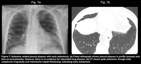 Causes Of Unilateral Transudative Pleural Effusion