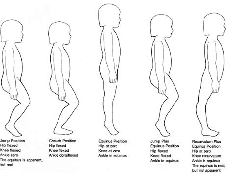 Severe crouch gait in the sagittal gait patterns of spastic diplegic ...