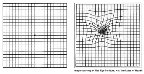 Dry & Wet AMD - Signs, Symptoms, and Diagnosis - Cure AMD Foundation