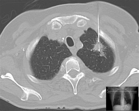 Lung biopsy - Wikipedia