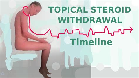 Topical Steroid Withdrawal