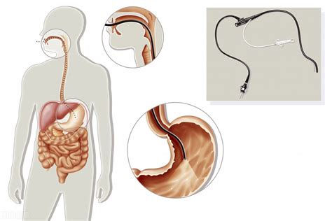 What is the process of gastroscopy?What are the characteristics of ...