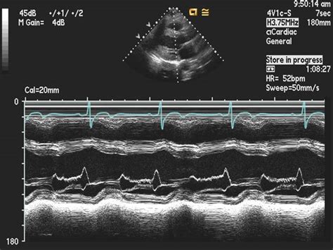 Aortic regurgitation echocardiography - wikidoc