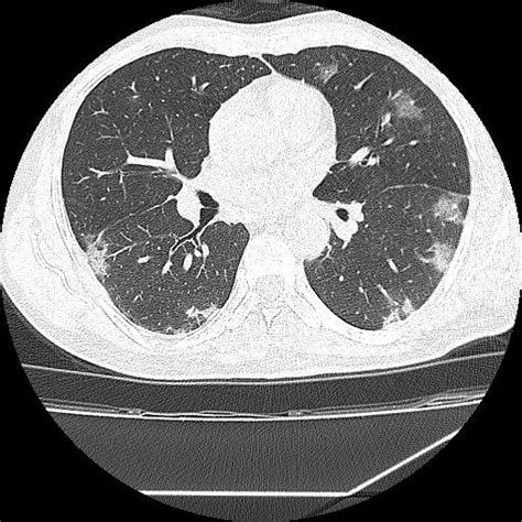 COVID-19 CT scan - wikidoc