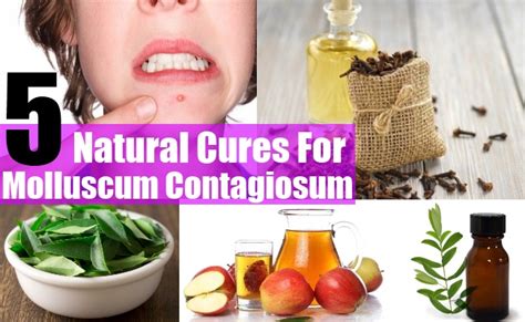 5 Natural Cures For Molluscum Contagiosum - How To Cure Molluscum Contagiosum Naturally ...