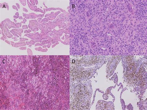 different histopathological features of PVNS. A. Large amount of... | Download Scientific Diagram