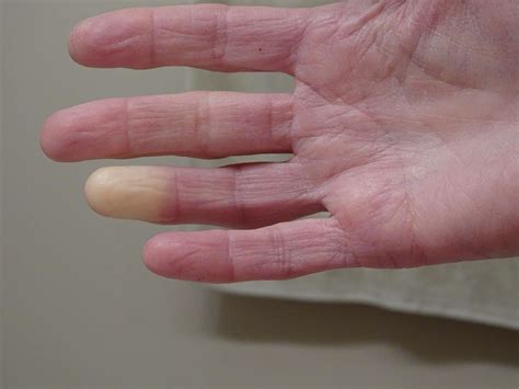 Types of Raynaud's Syndrome and How They Are Treated