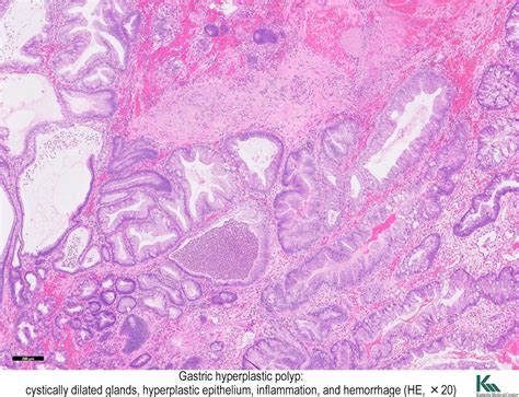 Pathology Outlines - Hyperplastic polyp