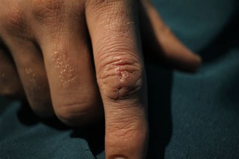 Scar Finger Stock Photo - Download Image Now - Adult, Adults Only, Blood - iStock