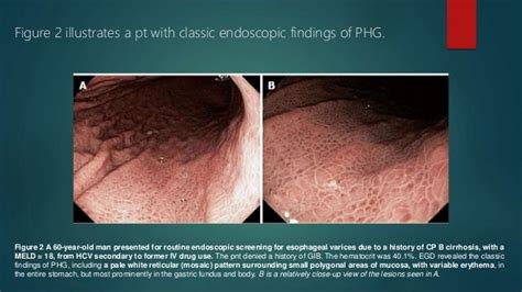 PORTAL HYPERTENSIVE GASTROPATHY