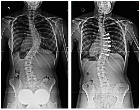 Non-fusion Corrective Scoliosis Surgery - Scoliosis and Spine Associates