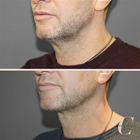 Defining Your Jawline with Vaser Liposuction - Cosmos Clinic