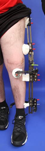 External Fixators | International Center for Limb Lengthening