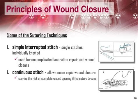 Types Of Wound Closure - Catalog Library