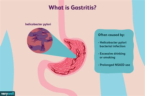 Gastritis: Symptoms, Treatment, Diet, and More