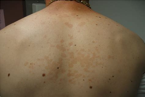 Harbor Hospital Resident's POW: 40 Yrs old with rash on his back