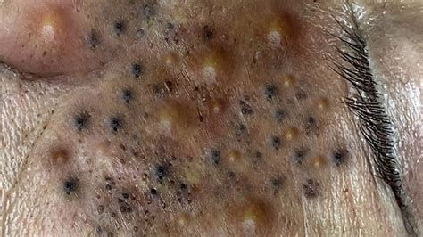 TREATMENT OF BIG BLACKHEADS AND HIDDEN ACNE FOR THE ELDERLY