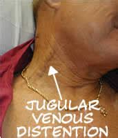 What it Looks Like: Jugular Vein Distention